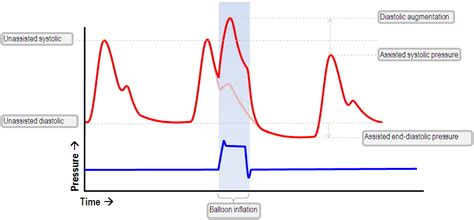 The Normal Iabp Waveform Deranged Physiology