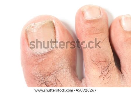 Foot Rot Stock Images, Royalty-Free Images & Vectors | Shutterstock