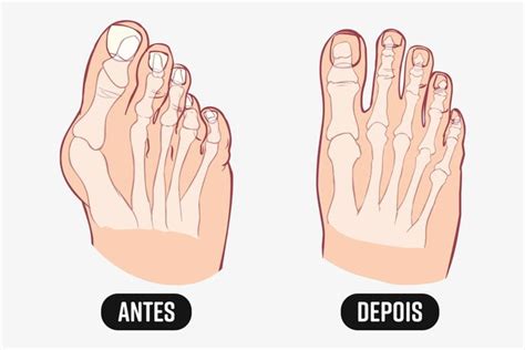 Cirurgia Joanete Antes E Depois - Cirurgia de joanete: quando fazer, recuperação e riscos - Tua Saúde