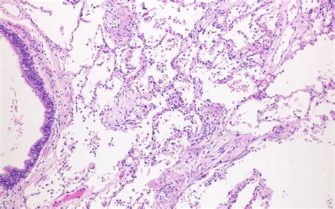 Pathology Outlines ARDS DAD