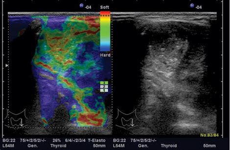 Elastography A New Ultrasound Technique In Nodular Thyroid Pathology