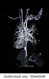 Cta Abdominal Aorta Ct Angiography 3d Stock Photo 2233714301 Shutterstock