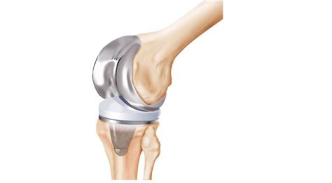 7 Characteristics of Knee Replacement Products - 360 Orthopaedics