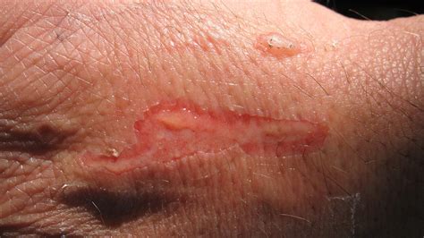 2nd Degree Burns Healing Stages Pictures Causes 53 Off