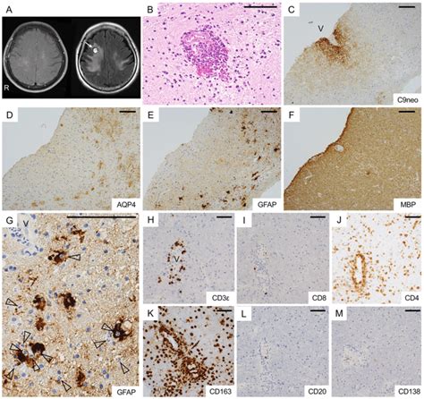 The Results Of Brain Biopsy Gadolinium Enhanced T Weighted Image On