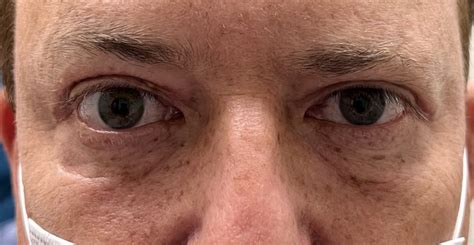 32 Eyelid Surgery Before And After Photos Dallas Plano Texas Cosmetic Reconstructive Eye Surgery