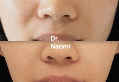 Nasolabial Folds Treatment Best Cosmetic Clinic Sydney Advanced