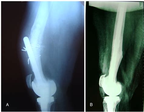 Periprosthetic Femoral Fracture After A Well Fixed Revision Total Knee