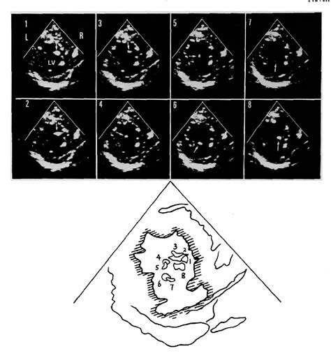 Figure 1 From Chaotic Echo Motion In The Left Ventricular Cavity