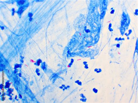 Mycobacterium Tuberculosis Positive Small Red Rod In Sputum Smear Acid Fast Stain Analyze By