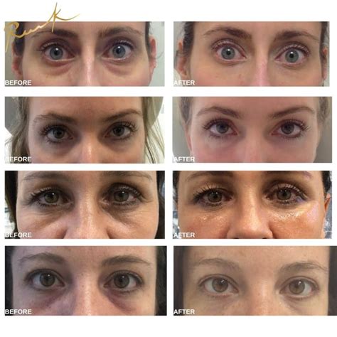 How To Get Rid Of Under Eye Wrinkles Botox Qeqe