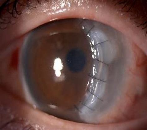 A Peripheral Cornea Thinning From To Oclock B Post Banana