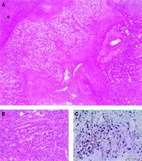 Representative Microscopic Photomicrographs Of A Primary Hepatic