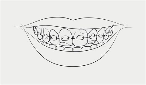 Smile With Teeth Braces In Linear Style Drawing On White Background