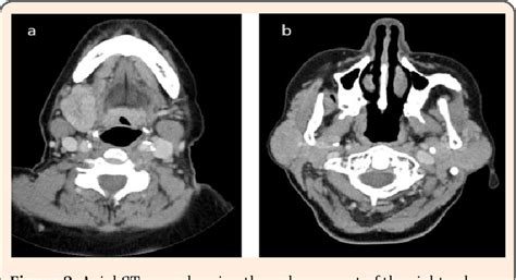 Figure 3 From Kuttners Tumor Of Bilateral Submandibular And Parotid