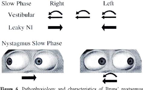 Spontaneous and Gaze-evoked Nystagmus | Semantic Scholar