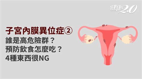 子宮內膜異位症／誰是危險族群？如何預防子宮內膜異位症？5飲食必看子宮內膜異位症危險族群子宮內膜異位症預防子宮內膜異位症能根治嗎