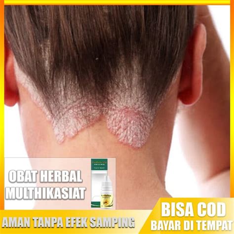 Jual Obat Ketombe Berkerak Koreng Di Kulit Rambut Kepala Obat Kulit