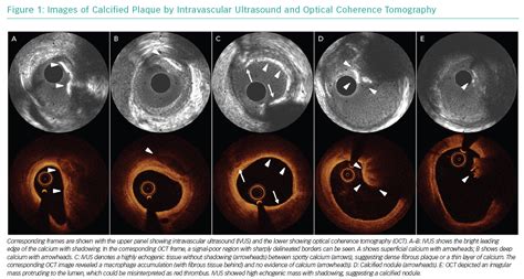 Images of Calcified Plaque by Intravascular Ultrasound and Optical ...