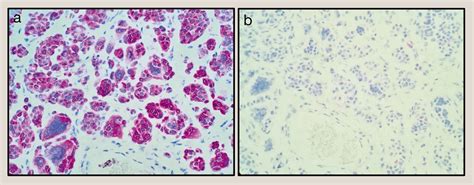 Benign Intradermal Melanocytic Naevus With Osteoclast Like Giant