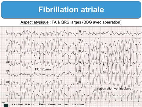 D Finitions Page Sur E Cardiogram