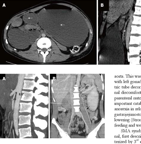 Figure 2 From A Rare Cause Of Obstructive Jaundice And Gastric Outlet