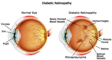 Diabetic Eye Disease Win Retina