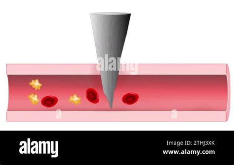 Hemostasis. Basic steps of wound healing process. Animate Stock Video ...