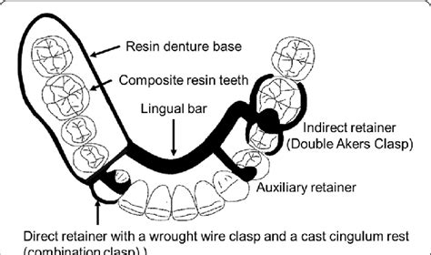 Basic design of removable partial denture | Download Scientific Diagram