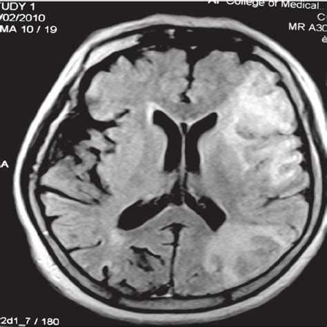 CT brain scan of Patient 5 showing large left opercular infarct and a... | Download Scientific ...