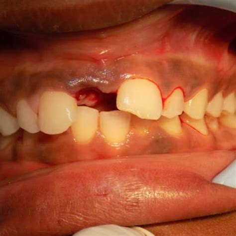 Classification Of Mesiodens Adapted From Khatri MP Samuel