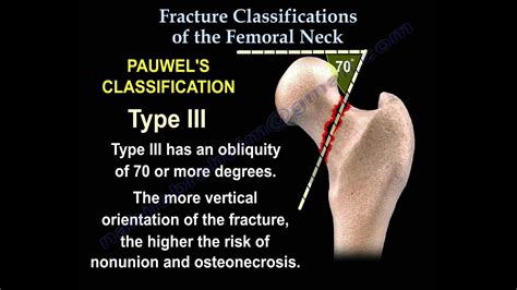 Femoral Neck Fracture