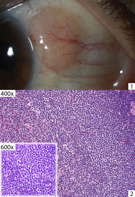 Limbal Mantle Cell Lymphoma Of The Conjunctiva Ophthalmology