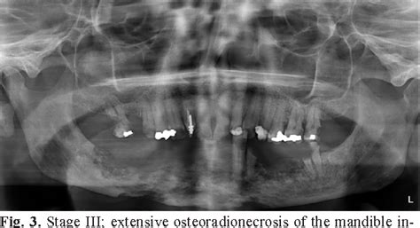 Figure 1 From Proposal For A New Staging System For Osteoradionecrosis