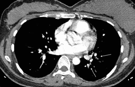 Axial View Of Ctpa Revealing Filling Defects In The Left Lower Lobe