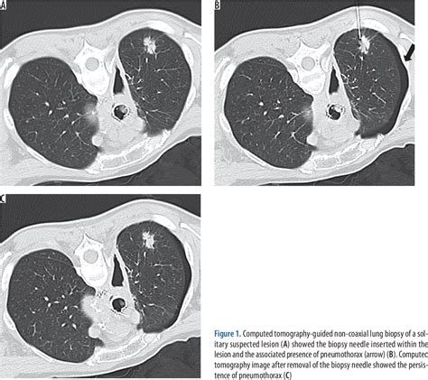 Figure 1 From Risk Factors Of Pneumothorax And Chest Tube Placement