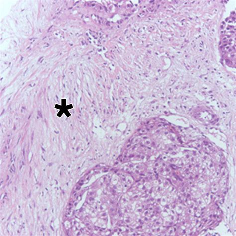 Hepatocellular Carcinoma Variants Radiologic Pathologic Correlation Ajr