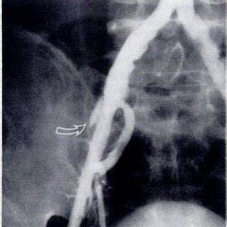 (PDF) Iliac artery stenosis or obstruction after unsuccessful balloon ...