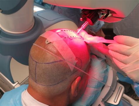 ARTAS Robotic Hair Transplants Bernstein Medical