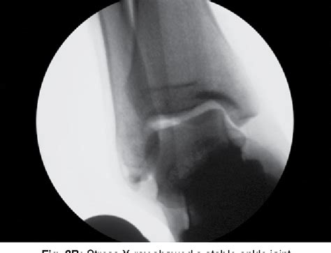 Minimally Invasive Reconstruction Of Anterior Talofibular Ligament With