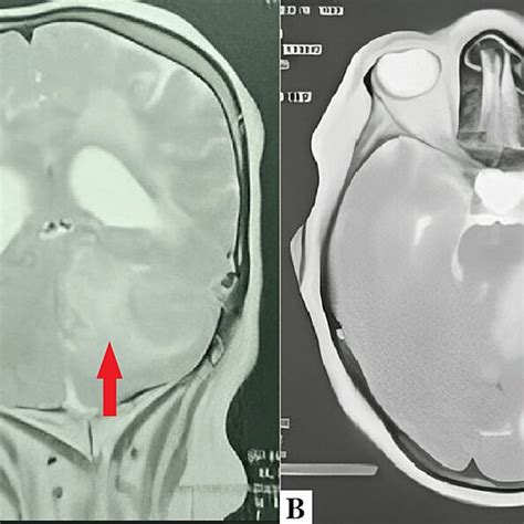 Cerebral Mri Of The Patient Showing A Left Cerebellar Pontine Angle