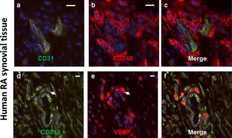 CD248 Marker Of Perivascular MSC With Potential Pathogenic Activities