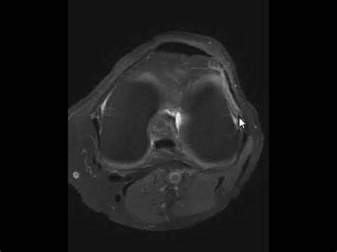 Knee MRI Scan ITB Iliotibial Band Friction Syndrome YouTube