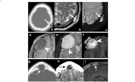 Epidermoid Cysts A C And D F And Dermoid Cyst G I Case 1 A C