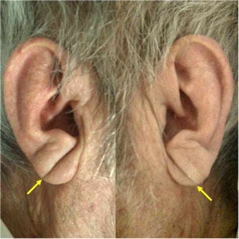 A Diagonal Earlobe Crease European Journal Of Internal Medicine