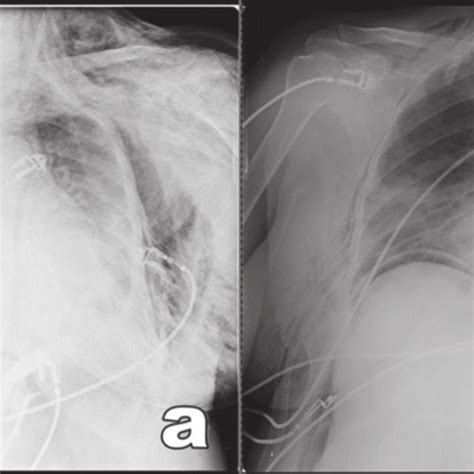 A Chest X Ray Shows The Tracheostomy Cannula And Bilateral