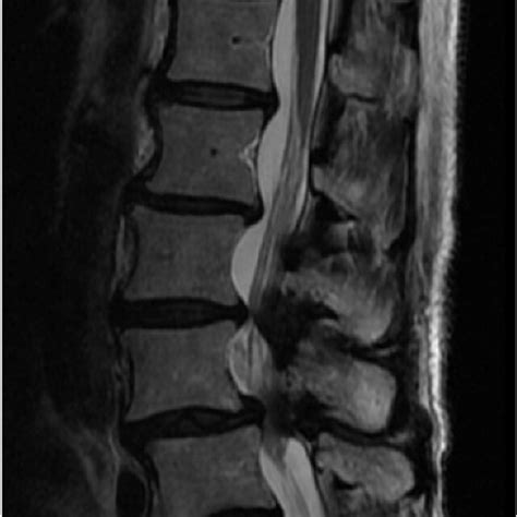 Patient Two Preoperative Mid Sagittal T2 Weighted Mri Download Scientific Diagram