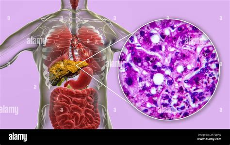 Liver Cirrhosis Computer Illustration And Light Micrograph Of A