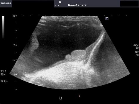 ON - RADIOLOGY: Ultrasound showing Bilateral communicating hydrocele in ...