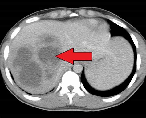 Liver Abscess Causes Symptoms Diagnosis Treatment And Prognosis